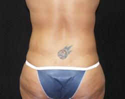 Postop Posterior